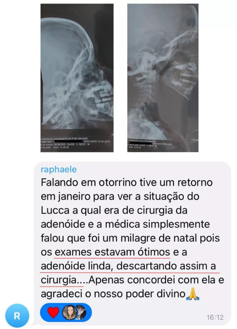 Depoimento - Cirurgia de Adenoide descartada