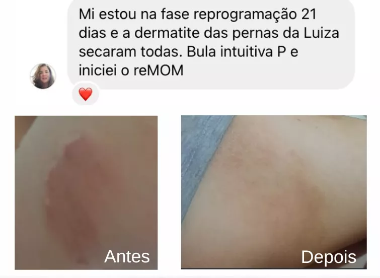 Depoimento - Dermatite resolvida