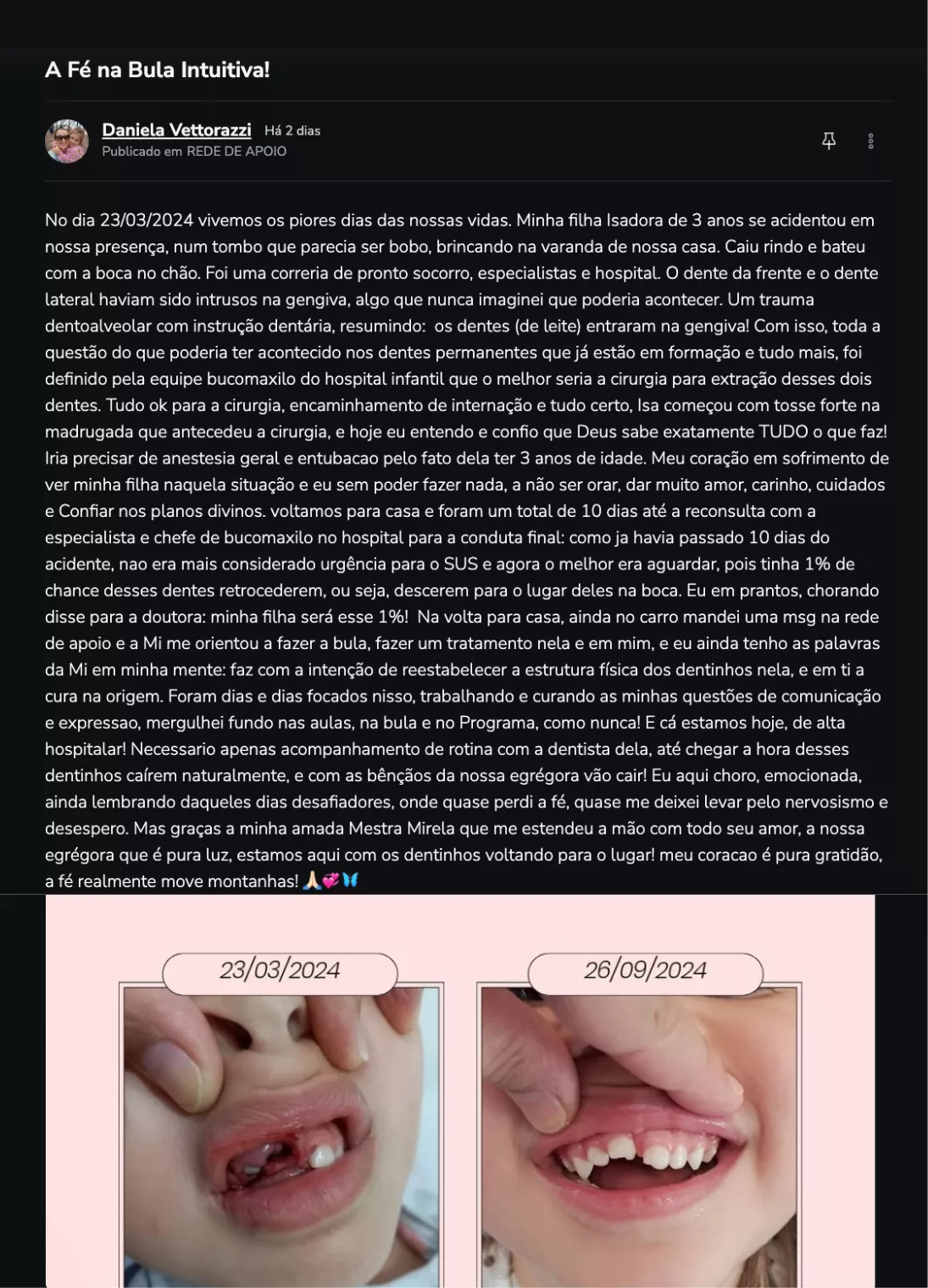 Depoimento - Descida dos dentes